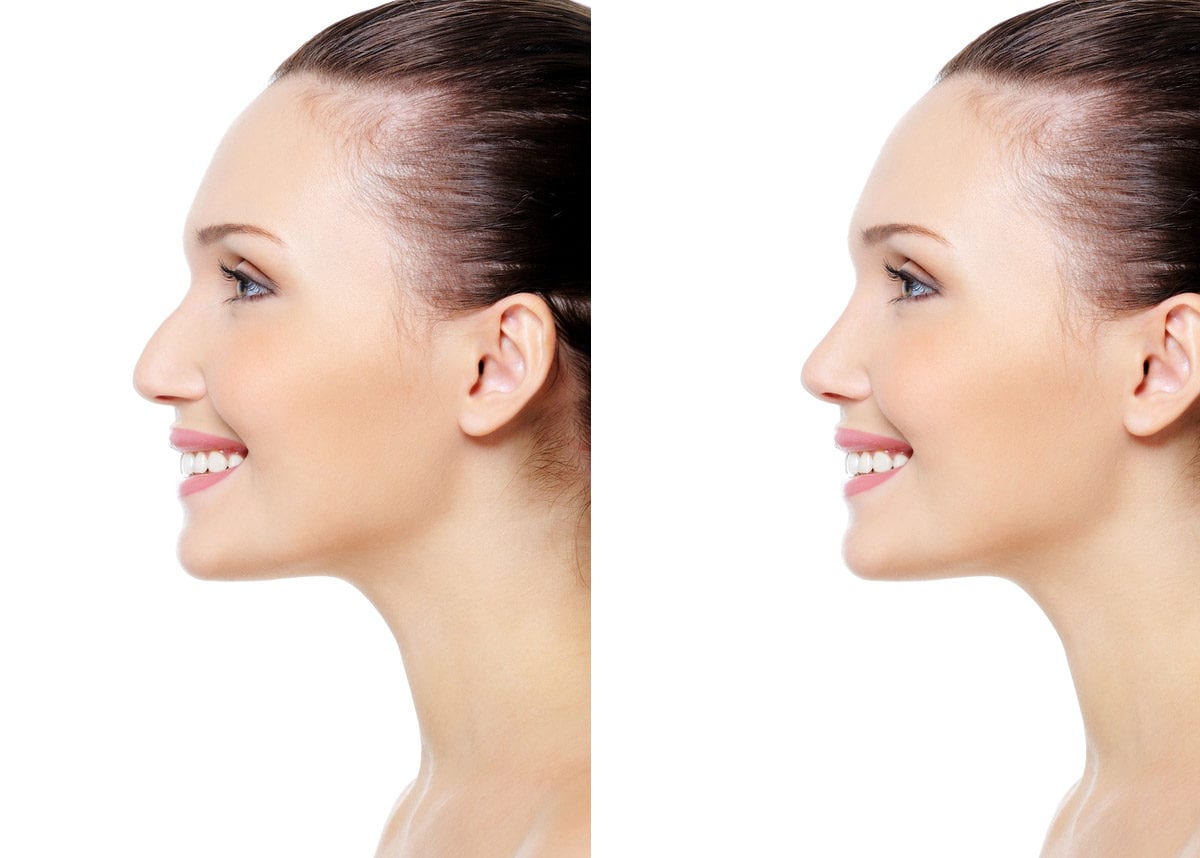 Burun Estetik Ameliyatı Nasıl Yapılır?